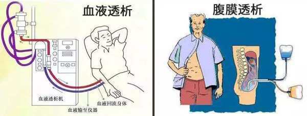 腹膜透析和血液透析的区别
