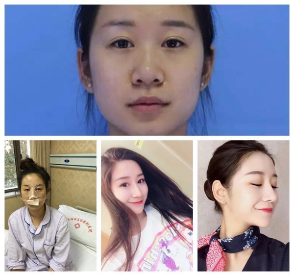 自体软骨隆鼻有来自哪些优点