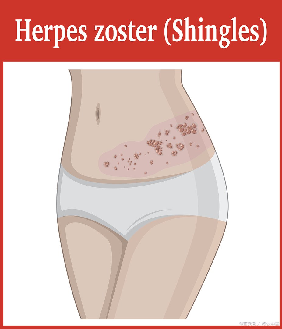 带状疱疹患者的日常注意事项是的什么啊？