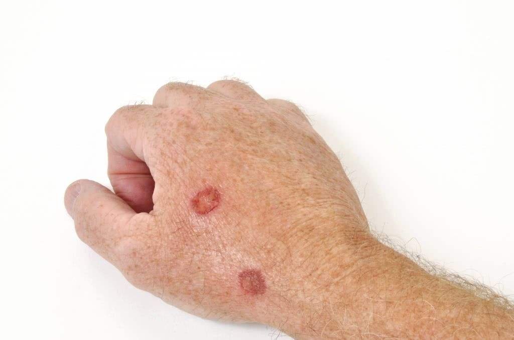 刺猴如何治疗才能除根