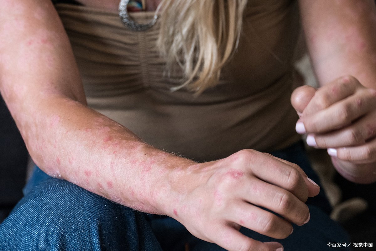 刺猴如何治疗才能除根