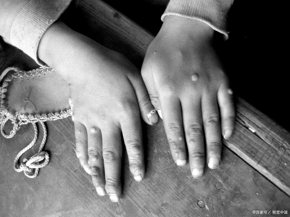 刺猴如何治疗才能除根