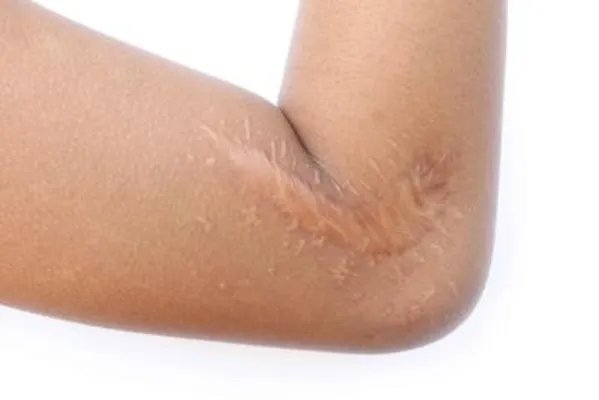 怎么做才能淡化疤痕