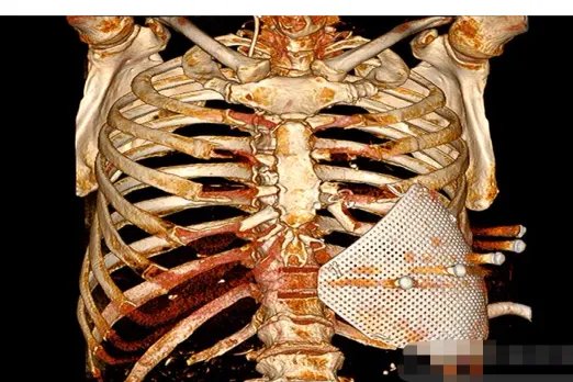 胸腔解剖结构图解3d