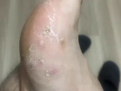 水疱型足癣水疱图片