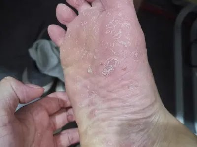 水疱型足癣水疱图片