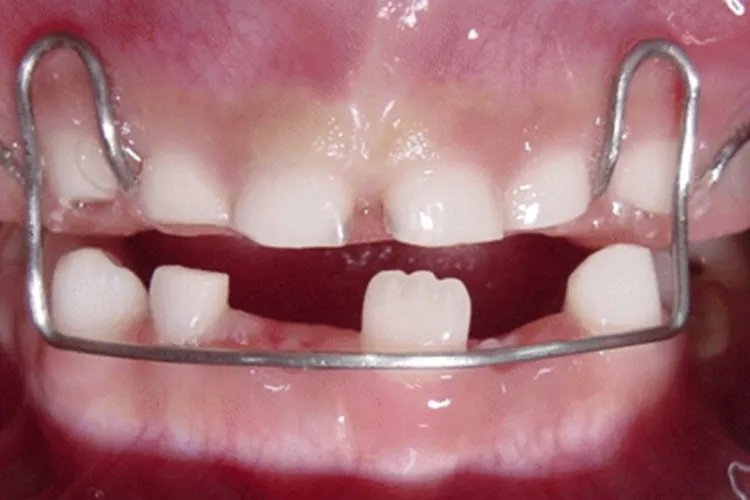 儿童牙齿矫正图片