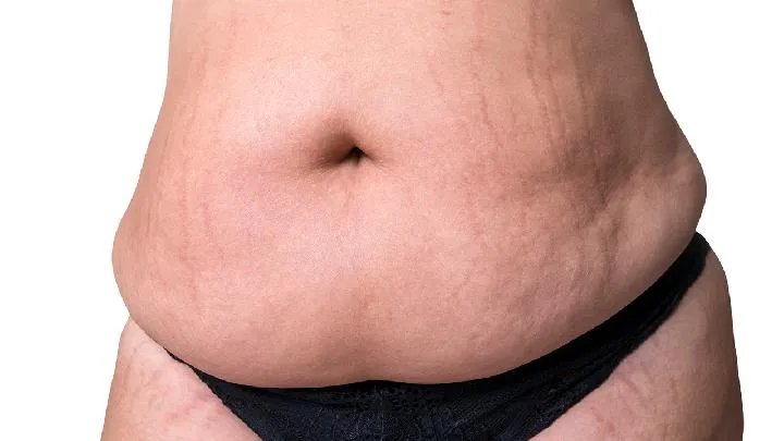 如何去治疗妊娠纹