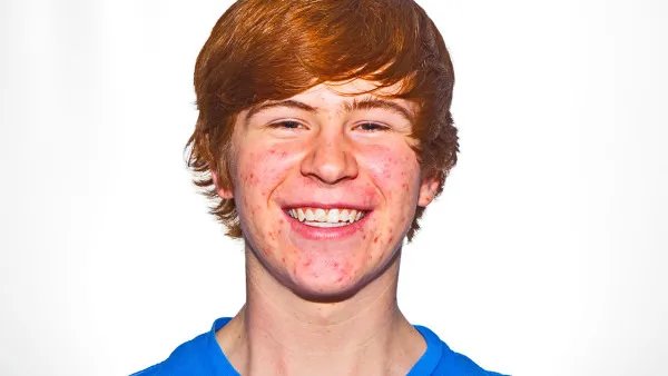 脸上长痘痘怎么治