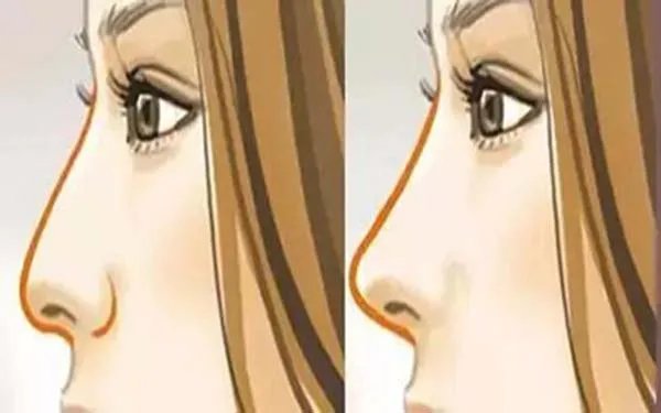 北京好的鼻部手术整形医院在哪