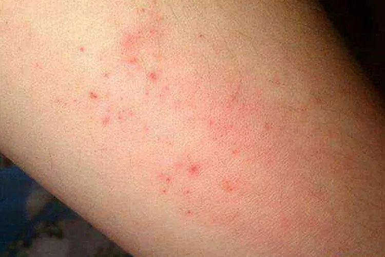 儿童白血病出血点图片