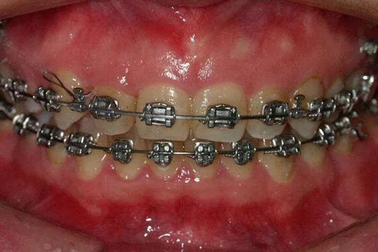 儿童牙齿矫正图片