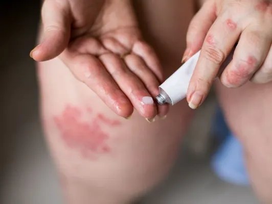 丘疹性荨麻疹的治疗