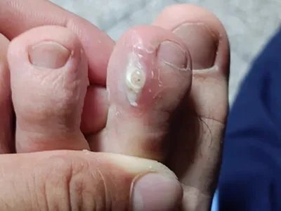 水疱型足癣水疱图片