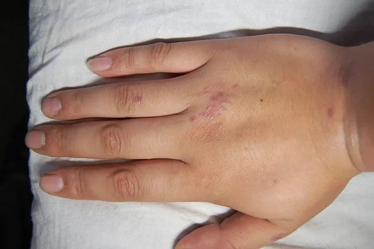 手上湿疹图片