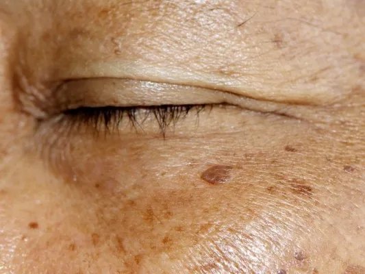 祛斑有什么方法