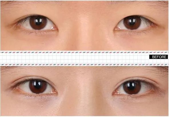 2021济南市艺星整形美容医院全切双眼皮价格表(价目表)怎么样?