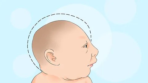 脑水肿后遗症需多久能表现出来