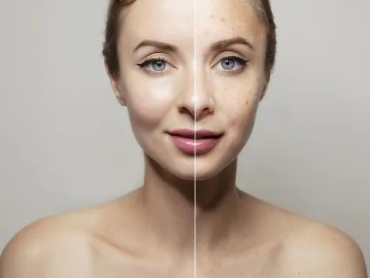 脸颊长痘痘的原因