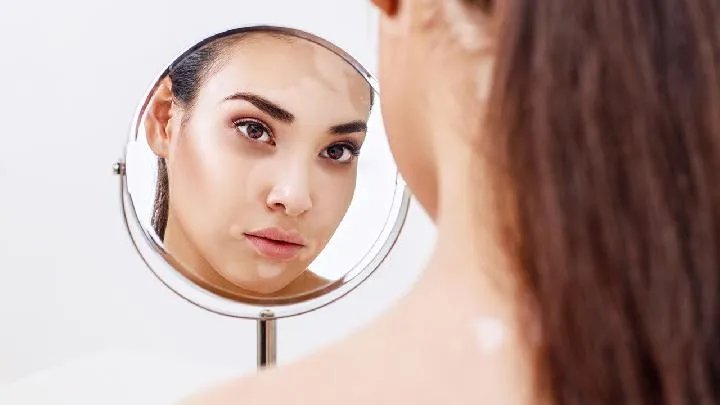 白癜风偏方有哪些呢