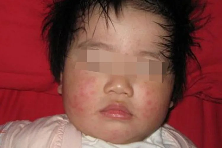 轻度小儿风疹症状图片