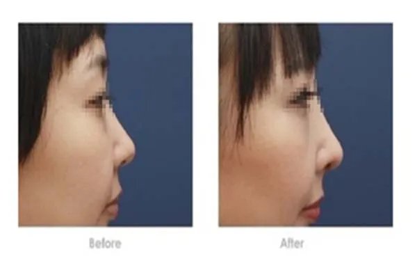 北京好的鼻部手术整形医院在哪