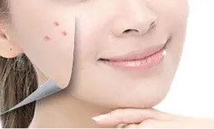 激光嫩肤副作用