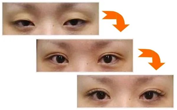 北京双眼皮医院哪里比较好?