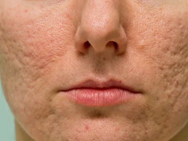 红糖去痘印有效吗