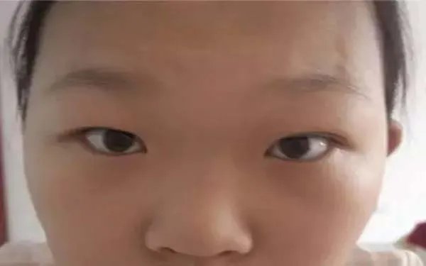 北京双眼皮医院哪里比较好?