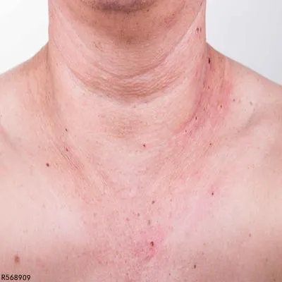 脖子上的皱纹怎么去除