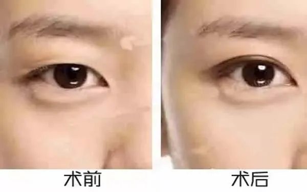 北京哪家医院割双眼皮好？