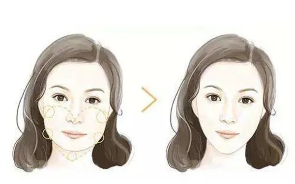 自体脂肪丰苹果肌的注意事项