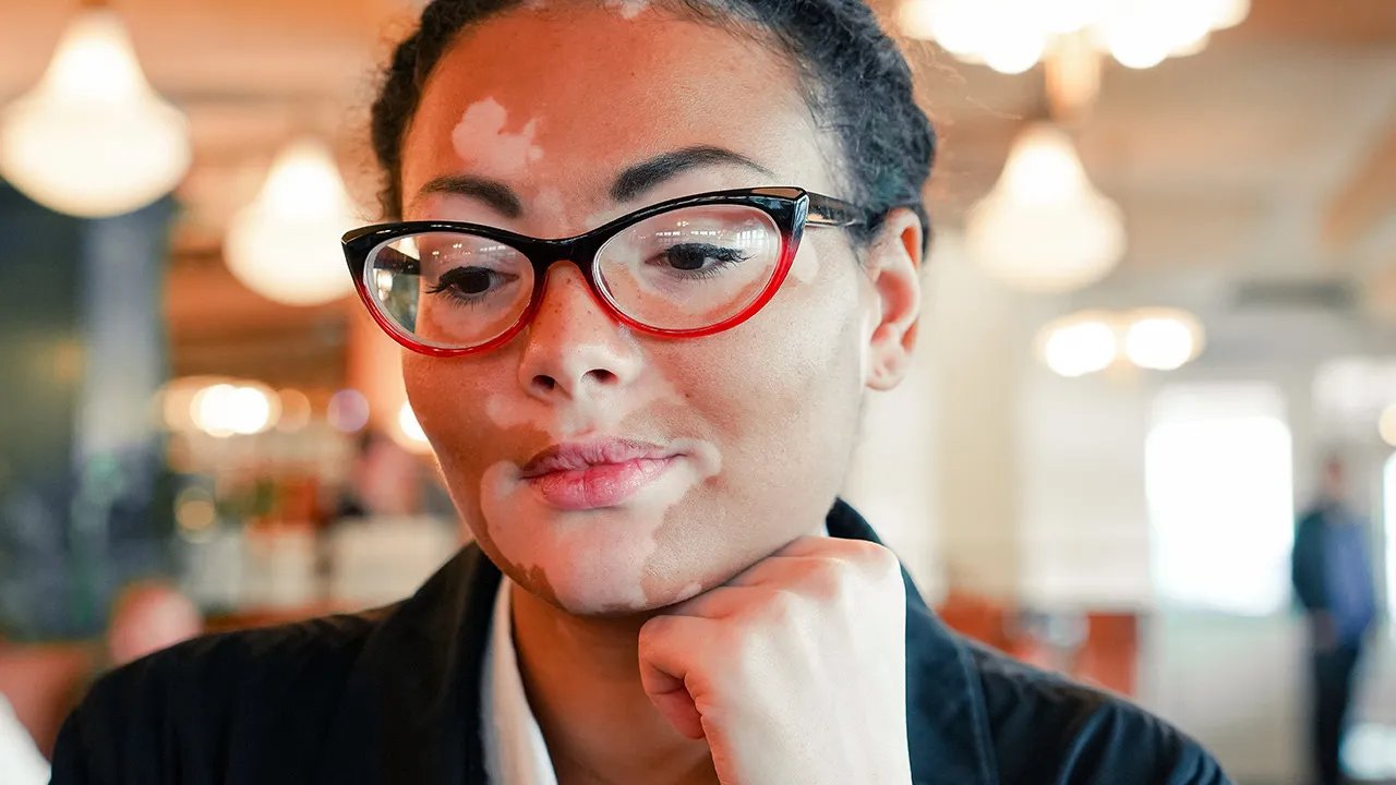 白癜风的早期症状有哪些