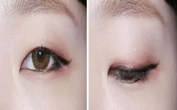 北京双眼皮医院哪里比较好?