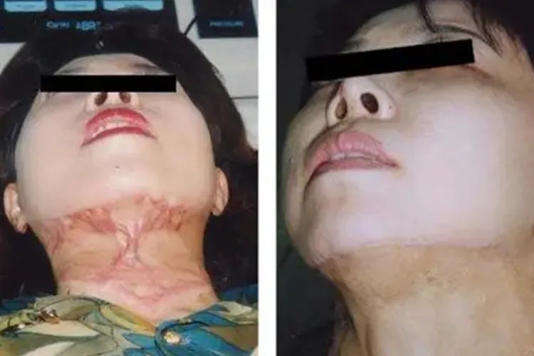 植皮完全恢复图片