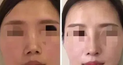 自体软骨隆鼻手术前后对比照(图)