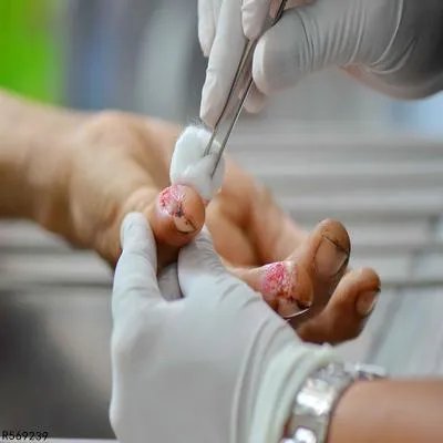 被烧伤起泡怎么处理