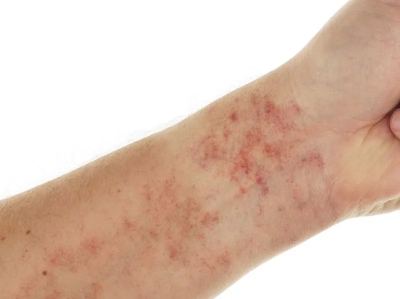 皮肤总过敏怎么办