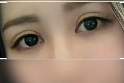 韩式埋线双眼皮多少钱