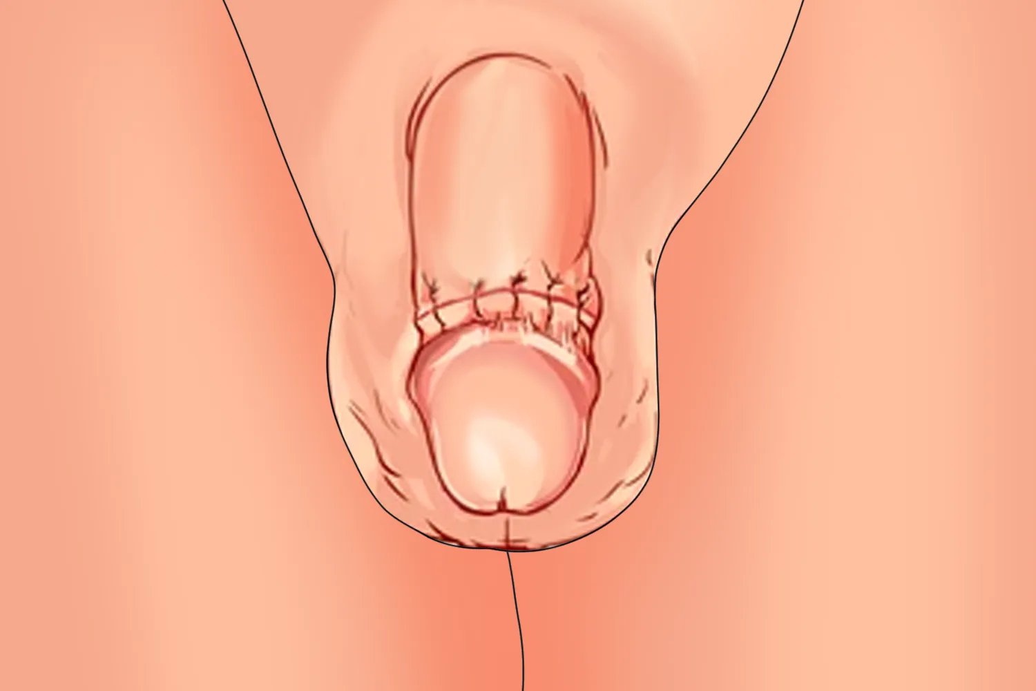 割完包茎后正常图片