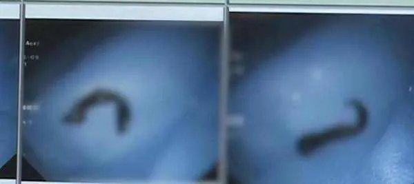 活体蚂蟥在5岁男孩体内存留1年多!它是怎么进去的?