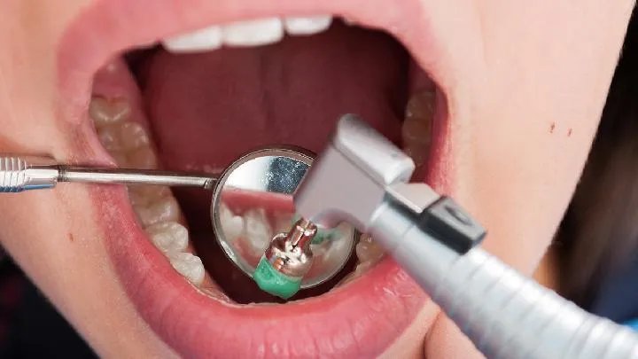 牙周炎该如何进行预防