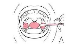 咽拭子采样正确手法图解