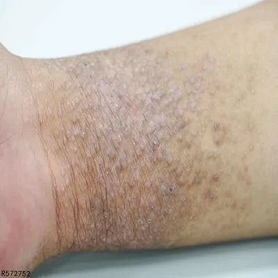 有哪些是牛皮癣的治疗方法