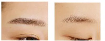 激光洗眉价格是多少