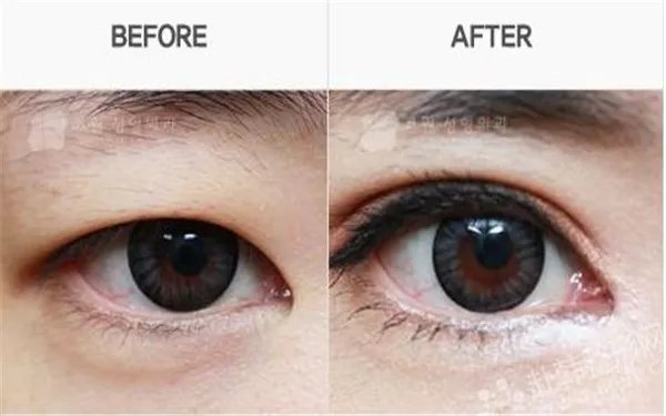 韩式开眼角多少钱