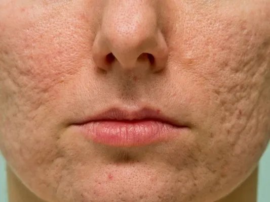 去黑头什么产品好