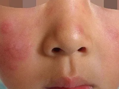 药物性狼疮面部丘疹图片