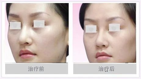 做鼻头缩小多少钱